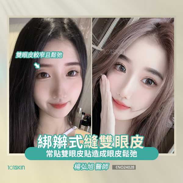 綁辮式雙眼皮