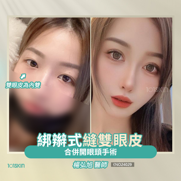 綁辮式雙眼皮