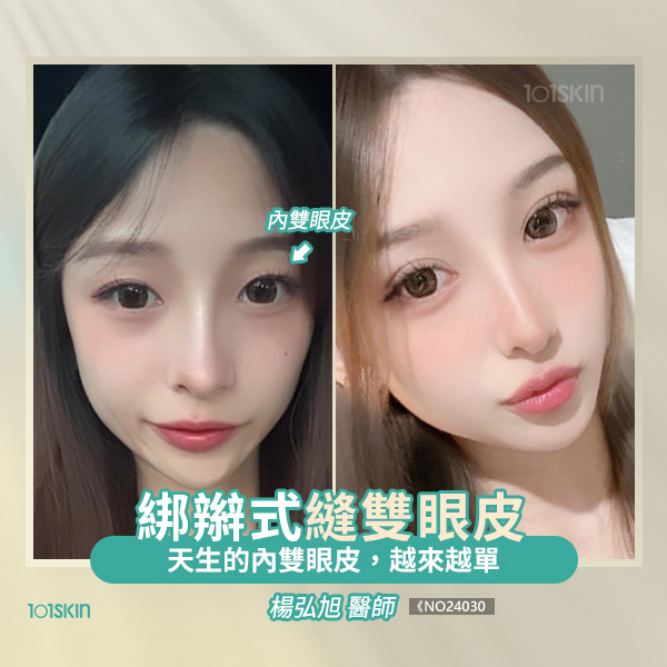 綁辮式縫雙眼皮
