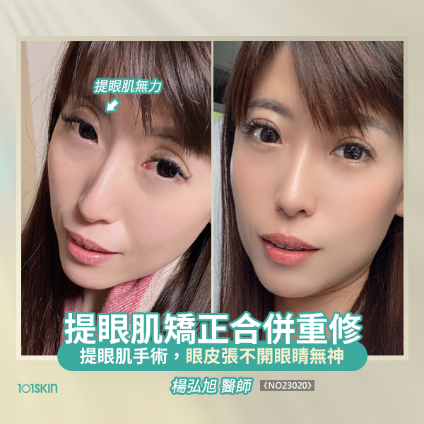 提眼肌矯正手術