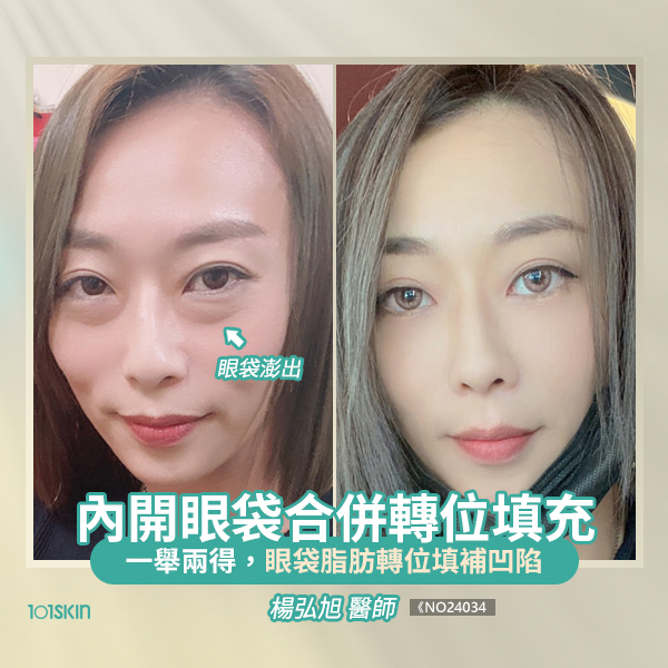 內開眼袋合併專位填充