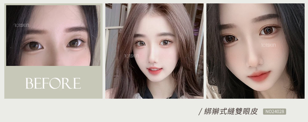 綁辮式雙眼皮