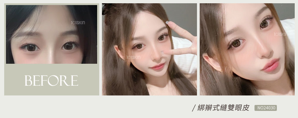 綁辮式雙眼皮