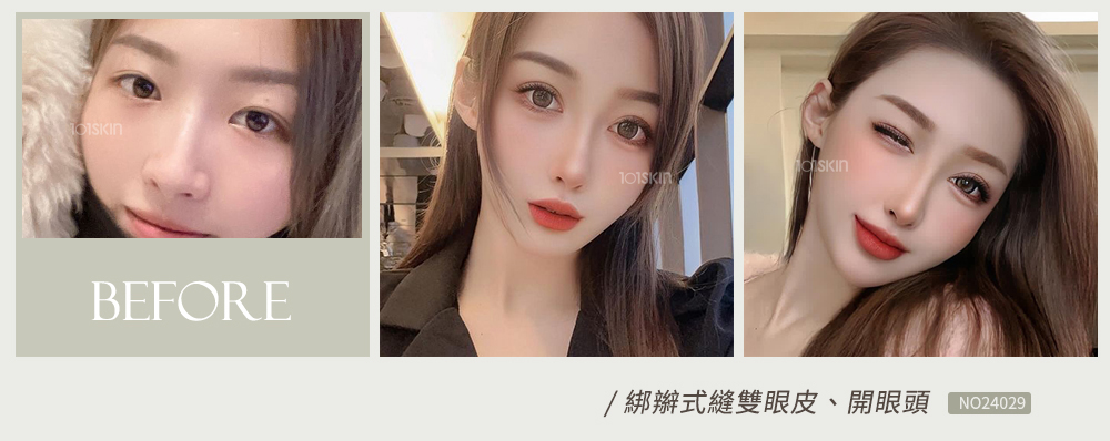 綁辮式雙眼皮